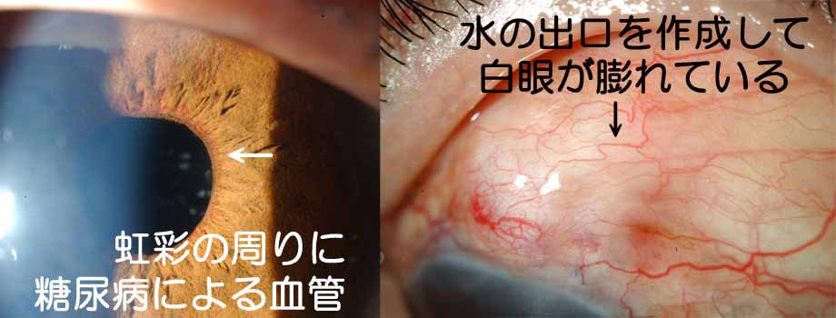 緑内障手術後