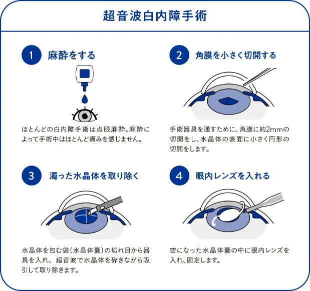 超音波白内障手術の流れ