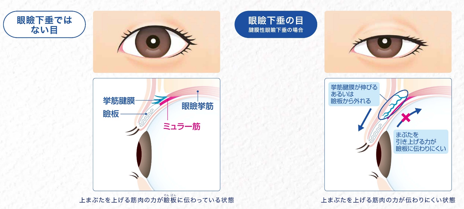 眼瞼下垂の模式図