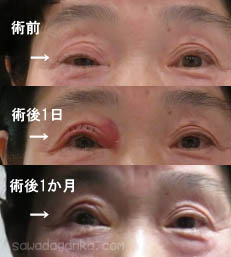 眼瞼下垂 術後