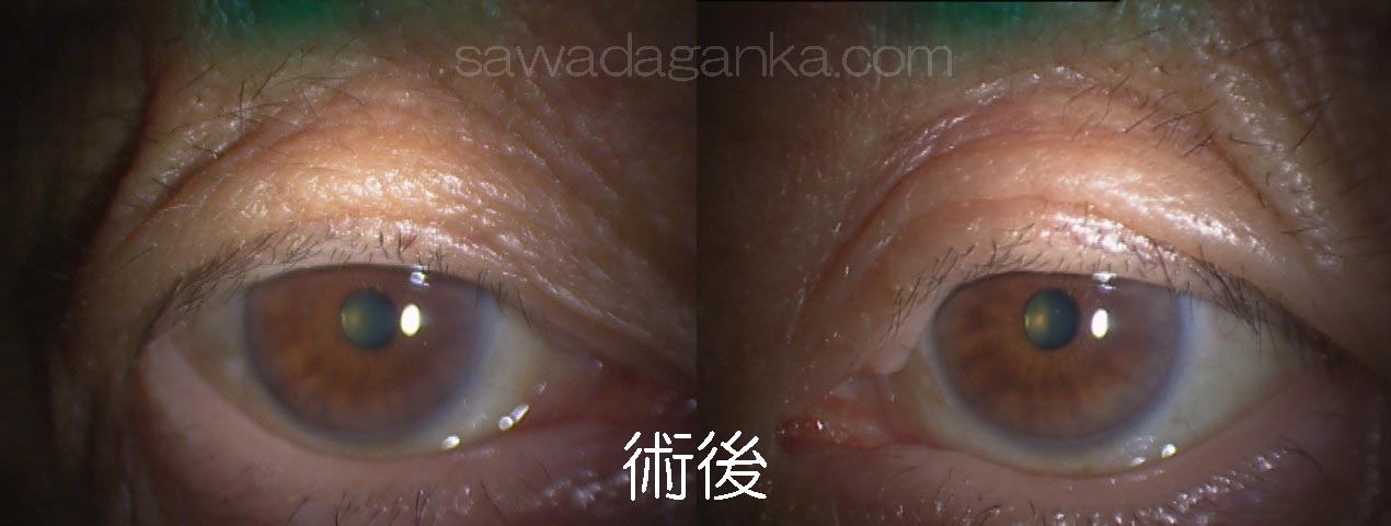 眼瞼皮膚弛緩 術後