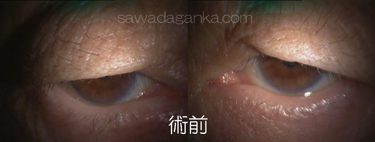 眼瞼皮膚弛緩 術前