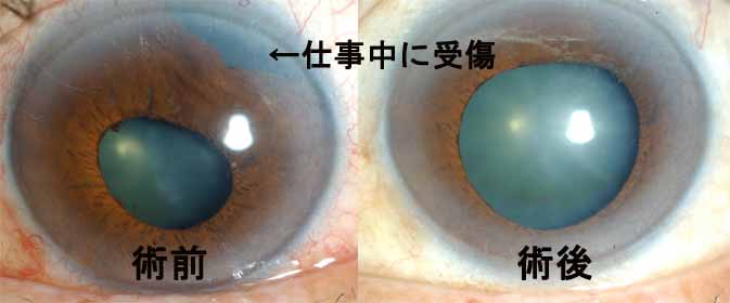 虹彩縫合術の症例
