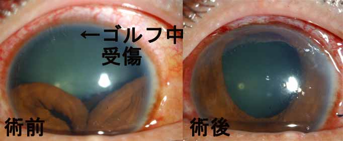 虹彩縫合術の症例2