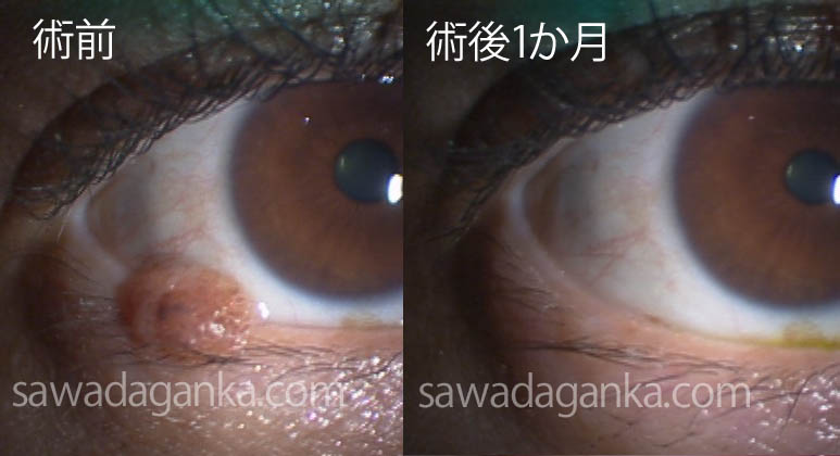 眼瞼縁の母斑