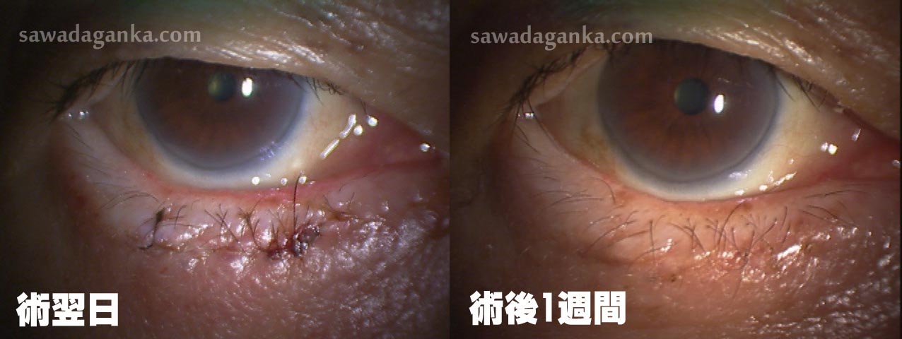 老人性内反症 術後