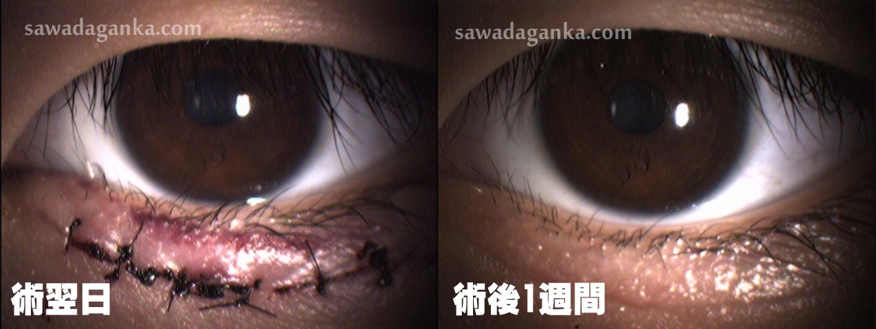若年性内反症 術後