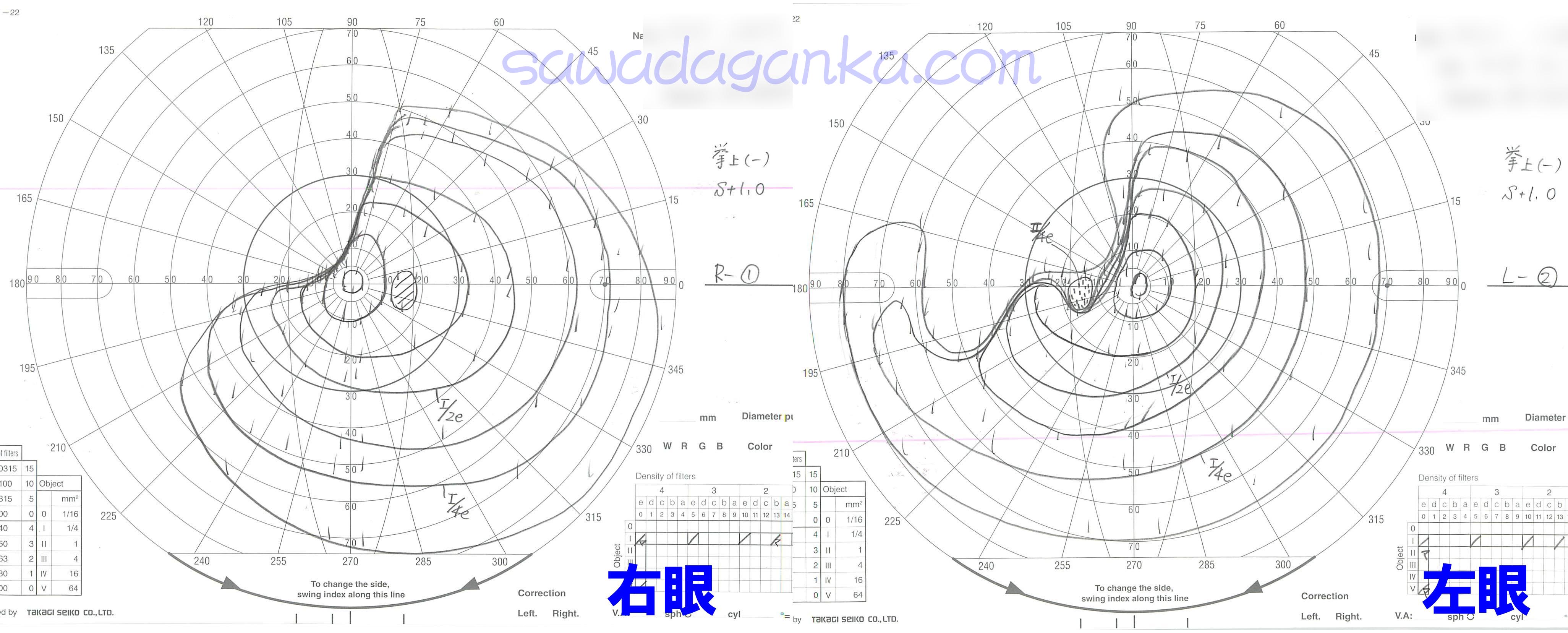 動的視野検査