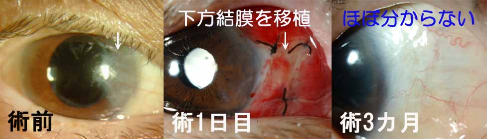 翼状片手術