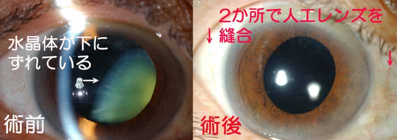 人工レンズ縫着術